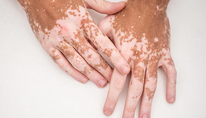 A Comprehensive Guide to Skin Conditions for People
