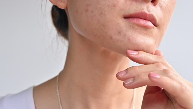 The Ins and Outs of Acne Scar Removal in Philadelphia